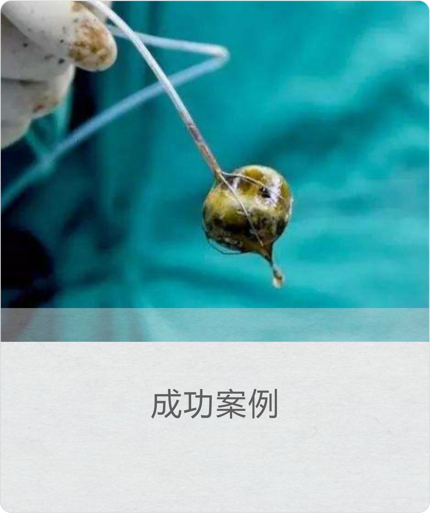 成功案例(急重症医学科-小结石引发呼吸心跳骤停)
